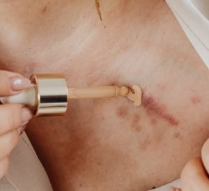 gambar bekas luka atau keloid. Ini dipakai untuk artikel Klinik Utama Dr. Indrajana membahas tentang keloid.