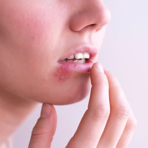 Penyakit Kulit Herpes Zoster - Klinik Utama DR Indrajana (1)