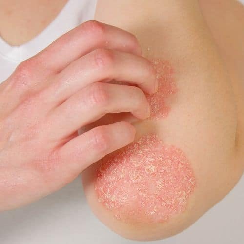 Penyakit Kulit Psoriasis atau kulit bersisik - Klinik Utama DR Indrajana (3)