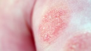 Dermatitis - Klinik Kulit dan Kelamin (1)