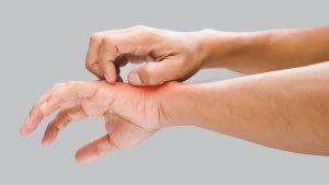 Dermatitis - Klinik Kulit dan Kelamin (3)