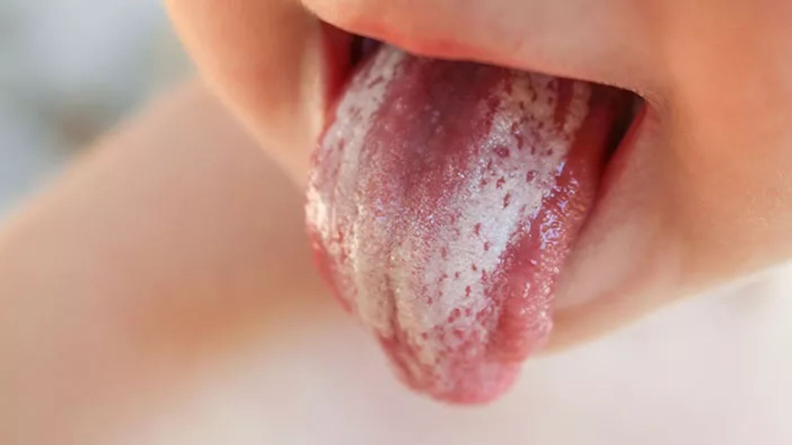 Gejala Infeksi Jamur Candidiasis - Klinik Utama DR Indrajana