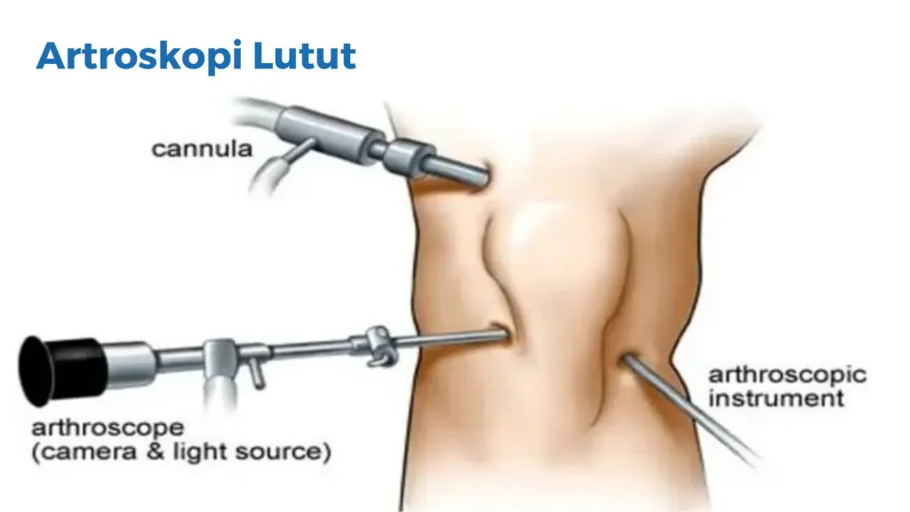 Prosedur Artroskopi - Klinik Ortopedi - Klinik Utama DR Indrajana