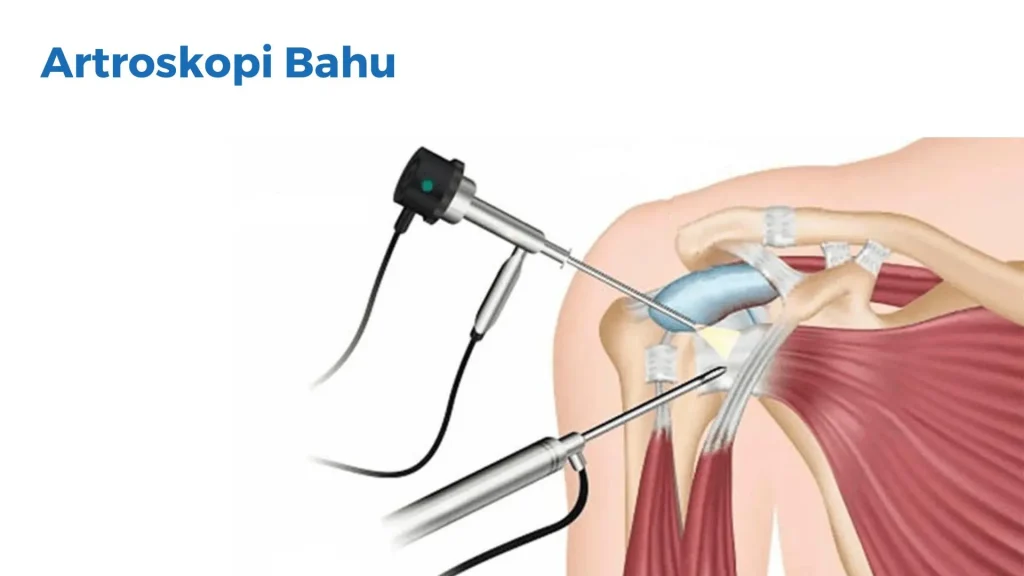 Prosedur Artroskopi - Klinik Ortopedi - Klinik Utama DR Indrajana