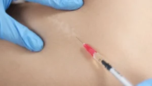 Injeksi Keloid - Klinik Utama DR Indrajana