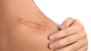 Injeksi Keloid - Klinik Utama DR Indrajana