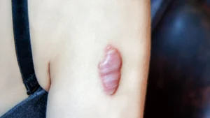 Injeksi Keloid - Klinik Utama DR Indrajana