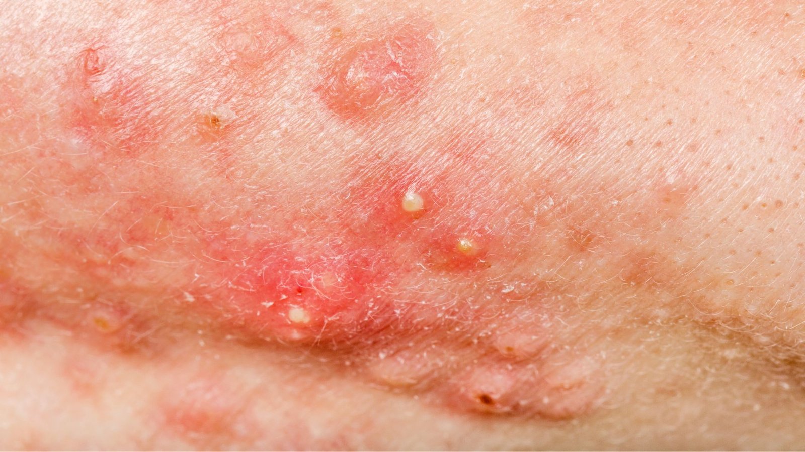 Suntik Jerawat Acne - Klinik Utama DR Indrajana